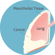  Asbestos Fibers in the mesothelial tissue