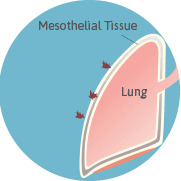 Asbestos Fibers lodging in the mesothelial tissue