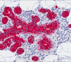 Stained Tissue Cancer Screening Stained Tissue Cancer Screening