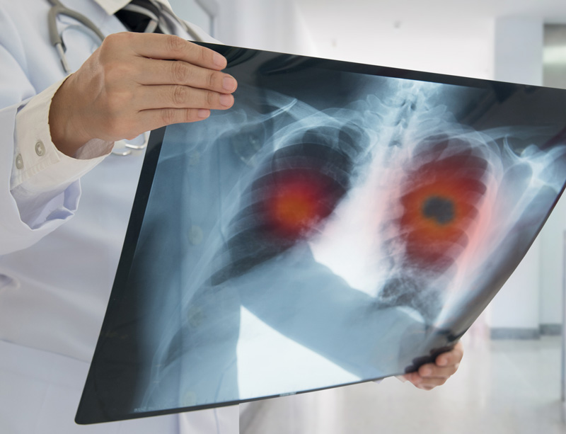 Lung cancer scan Lung cancer scan