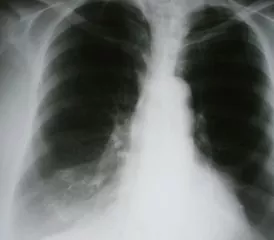 X-ray of lungs X-ray of lungs
