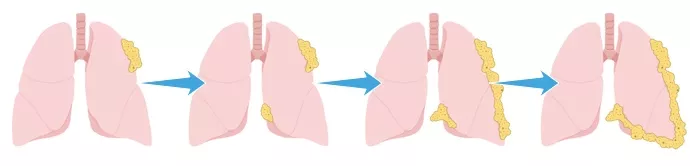 Four stages of mesothelioma tumors forming on the lungs.