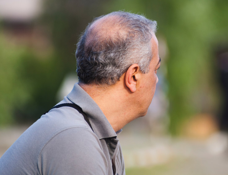 Man balding Man balding