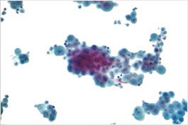 Histology Stain of Mesothelioma Tissue Histology Stain of Mesothelioma Tissue