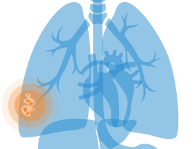 Asbestos fibers lodged in mesothelium causing inflammation