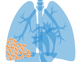 Mesothelioma tumor forming in mesothelium