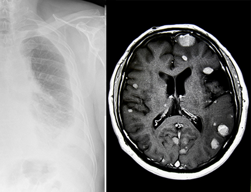 Can Mesothelioma Spread to the Brain?