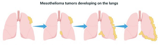 Four stages of mesothelioma tumors forming on the lungs