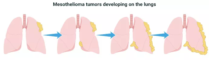 Four stages of mesothelioma tumors forming on the lungs.