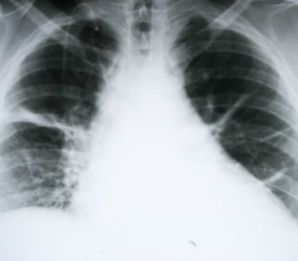 X-ray of mesothelioma X-ray of mesothelioma