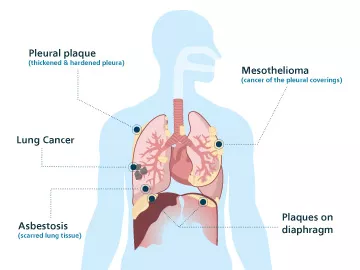 Mesothelioma