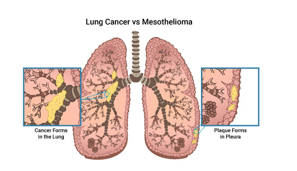 Diagram of a lung comparing malignant mesothelioma plaque in the lining versus a cancerous tumor