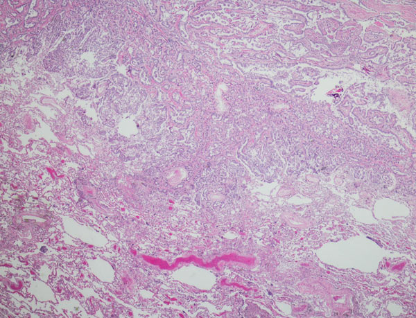 Micrograph stain of pleural mesothelioma Micrograph stain of pleural mesothelioma