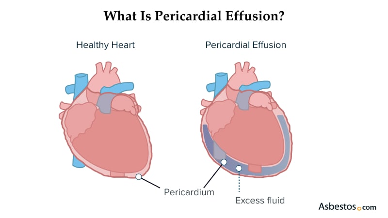 Diagram showing pericardial mesothelioma affecting the heart