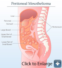 Peritoneal Mesothelioma Diagram