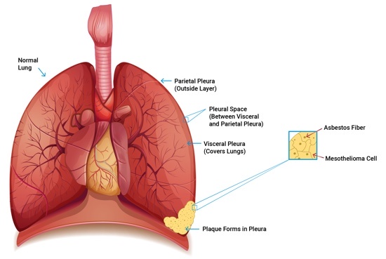 Pleural Mesothelioma  Symptoms, Diagnosis  Treatments