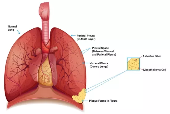Plaque forming on the pleura after decades of asbestos exposure