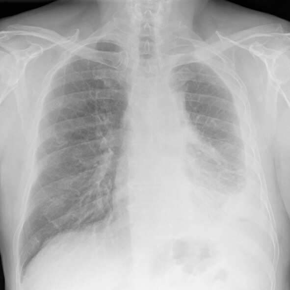 Digital chest x-ray of advanced malignant mesothelioma on left.