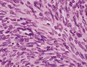 Sarcomatoid cells