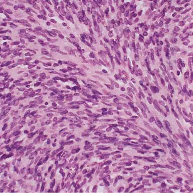 The 4 Types of Mesothelioma, Cell Types and Tailored Treatment
