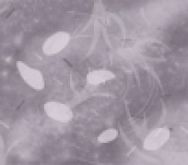 Mesothelioma cells Mesothelioma cells
