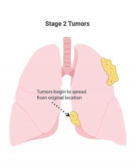 Stage 2 mesothelioma