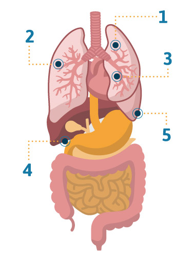 How do doctors treat lung disease caught at an early stage?