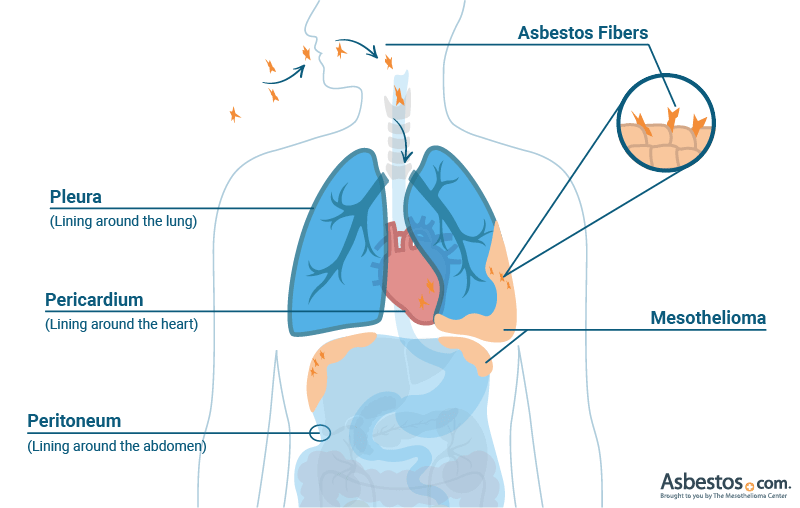 Mesothelioma developing in the pleura, peritoneum and pericardium