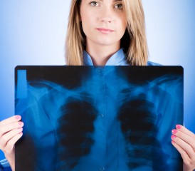 Woman holding X-ray of lung cancer Woman holding X-ray of lung cancer
