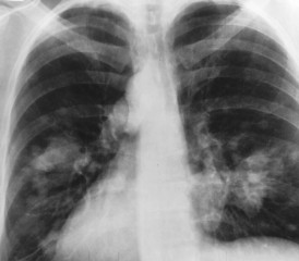 X-ray of lungs X-ray of lungs